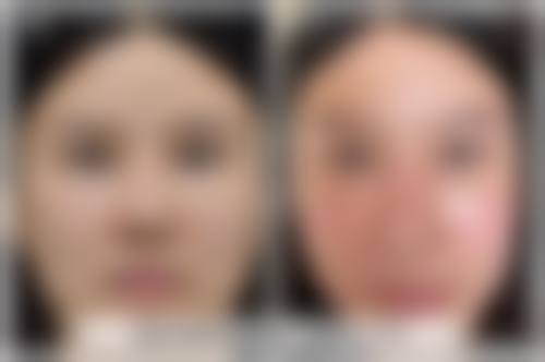 鼻部整形项目价目