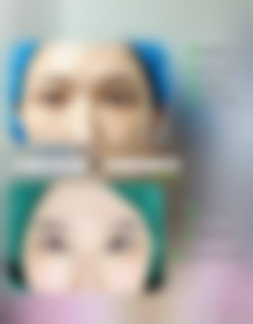 眼部整形项目价目