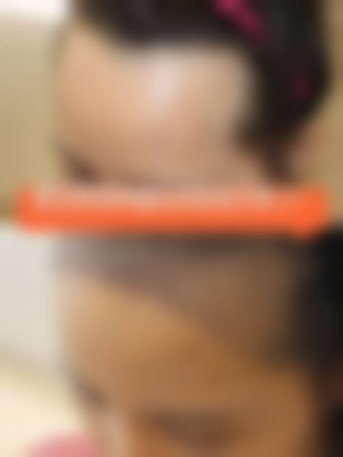 承德熙朵植发就诊指南