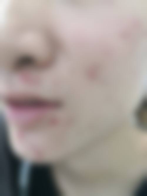 成都军康疤痕痤疮医学研究院核心项目