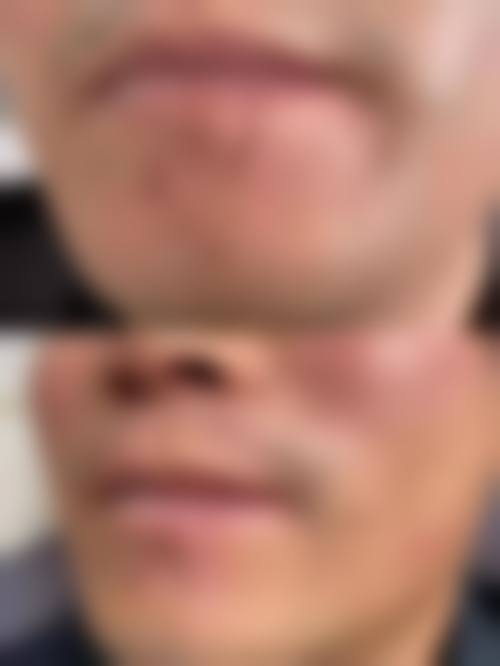 【青岛市立医院西院烧伤整形科真实患者评价】