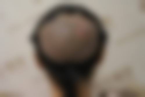 【六、厦门碧莲盛无痕植发整形真实患者口碑评价】