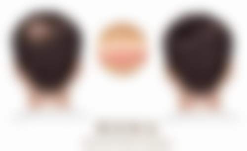 【二、福州碧莲盛植发医院擅长诊疗项目有哪些】