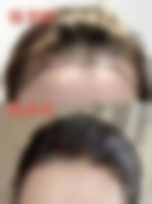 【六、石家庄大麦微针植发真实患者口碑评价】