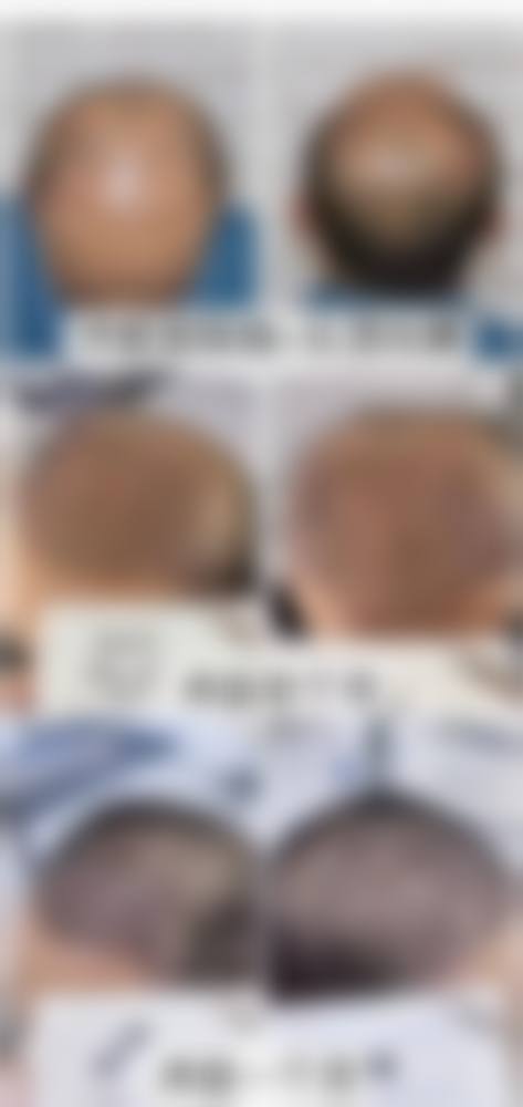 【二、石家庄大麦微针植发擅长诊疗项目有哪些】