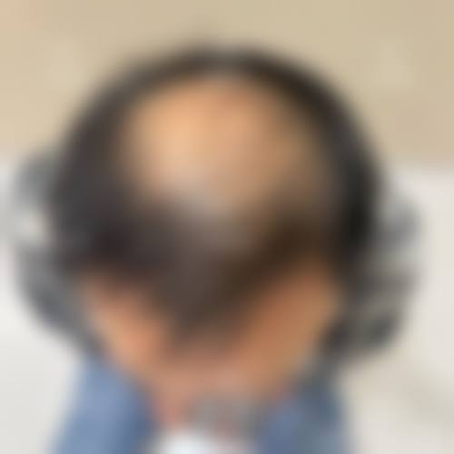 西宁碧莲盛植发医院怎么预约？