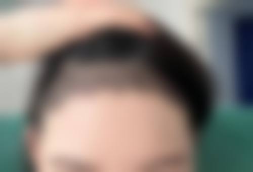 西安碧莲盛植发机构擅长项目