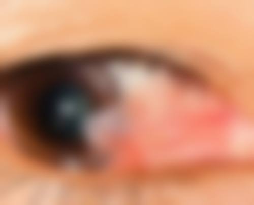 做完PRESBYOND老花矫正后，真实感受是怎样的？